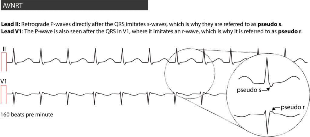 Figure 3. AVNRT in a 20-year old male suffering from palpitations.