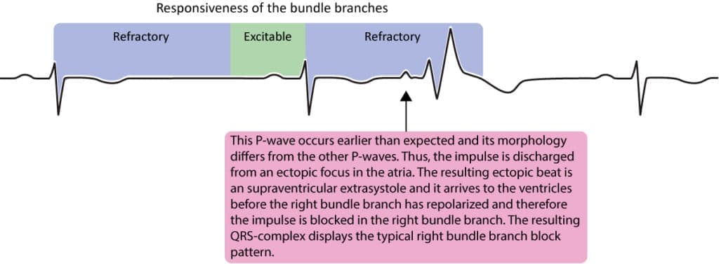 Figure 1. The figure shows a supraventricular extrasystole (i.e a premature atrial complex/beat) which is conducted with aberration. The supraventricular impulse reaches the His-Purkinje system while the right bundle branch is still refractory and therefore blocks the impulse. The resulting QRS complex has a right bundle branch block morphology (rSR pattern), which is due to aberrant ventricular conduction (aberration, aberrancy).