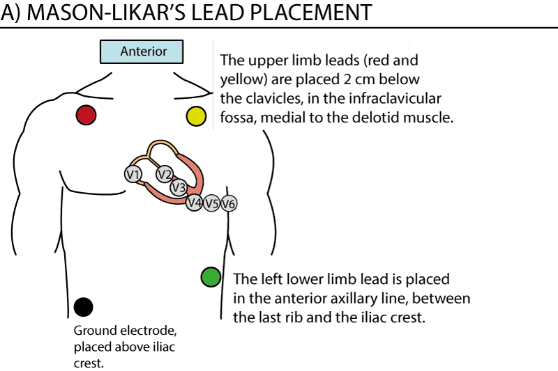 Figure 1. Lead placement for exercise ECG. Note that the precordial (chest) leads are placed normally. The limb leads are relocated to the torso, or proximally on the limbs. The lead placement depicted here is referred to as Mason-Likar's placement, with limb leads on the torso. This reduces artefacts (muscle disturbances) during exercise stress testing.