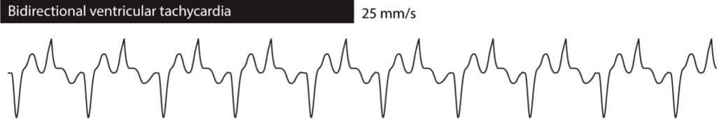 Figure 2. Bidirectional ventricular tachycardia