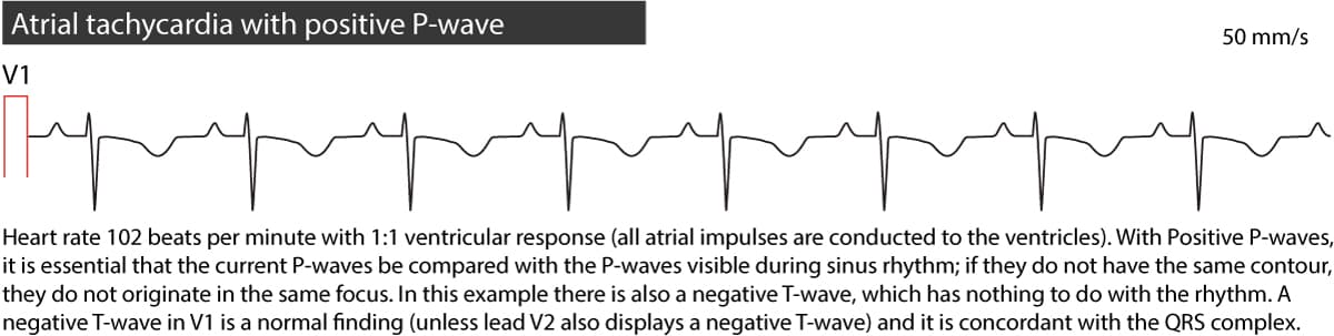 Figure 3. Atrial tachycardia.