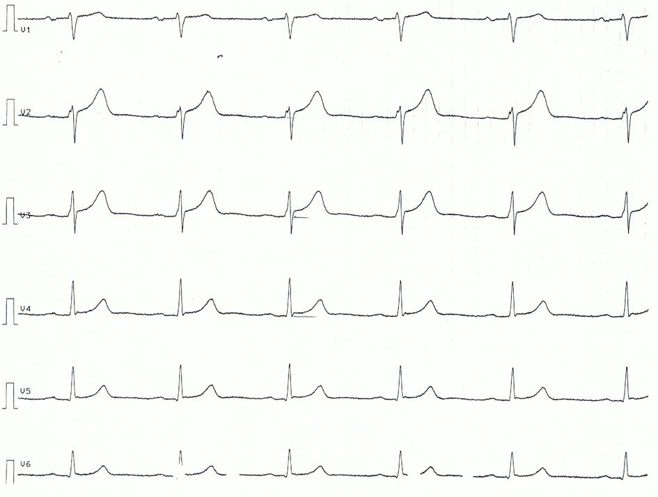Figure 3. Chest leads of patient with acute pericarditis. Note the ST segment elevations, concave ST segments.