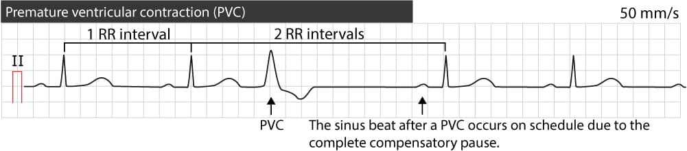 Figure 2. The complete compensatory pause following a premature ventricular contraction.