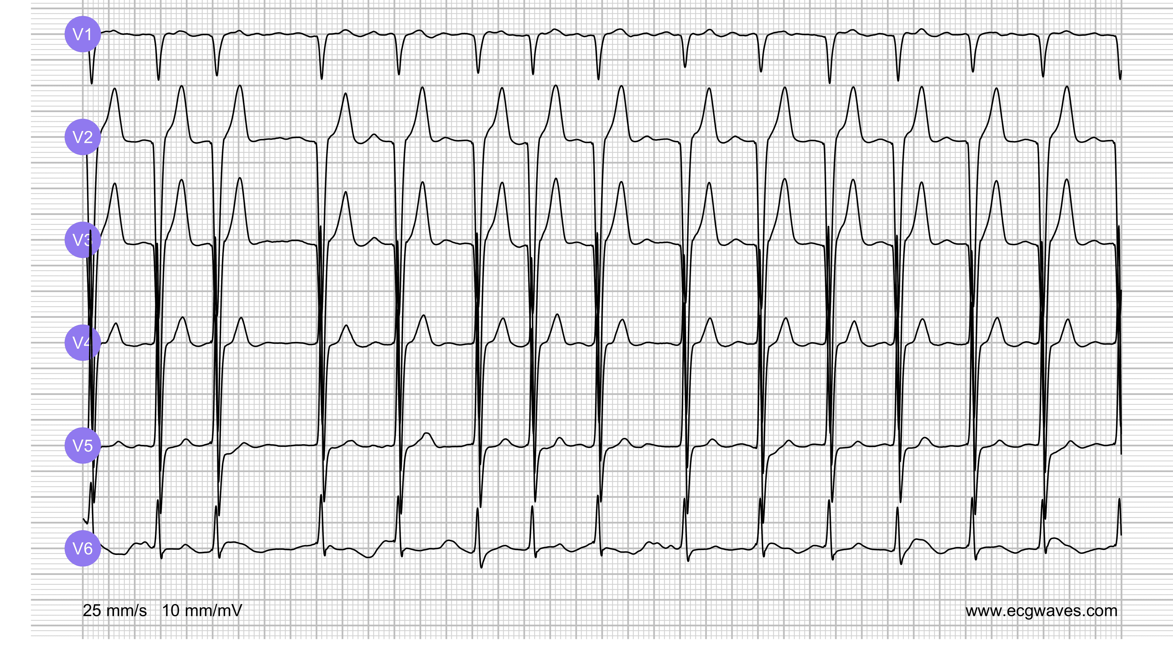 ECG Test (Quiz) Library: Question 2