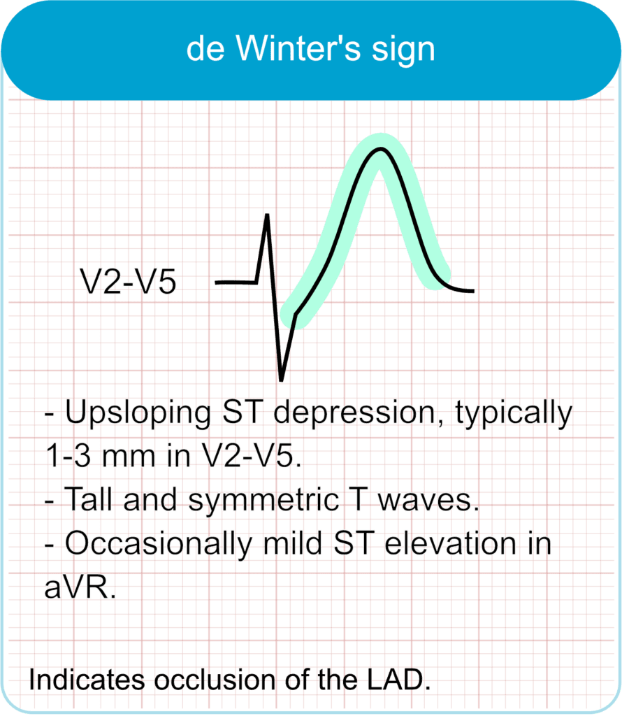 De Winter T-waves (De Winter sign)
