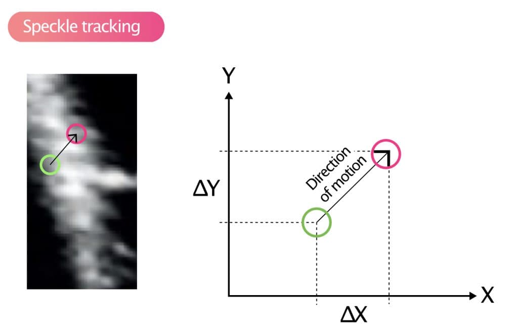 Figure 8. Speckle tracking.