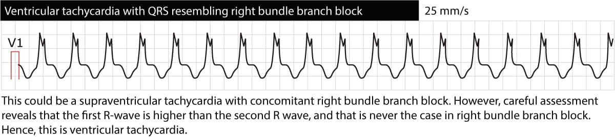 Figure 4. Ventricular tachycardia with right bundle branch block (RBBB) morphology. However, the first R-wave is larger than the second R-wave, which is not the case in RBBB. This suggests that the rhythm is not a supraventricular tachycardia conducted with RBBB, but rather ventricular tachycardia (VT).