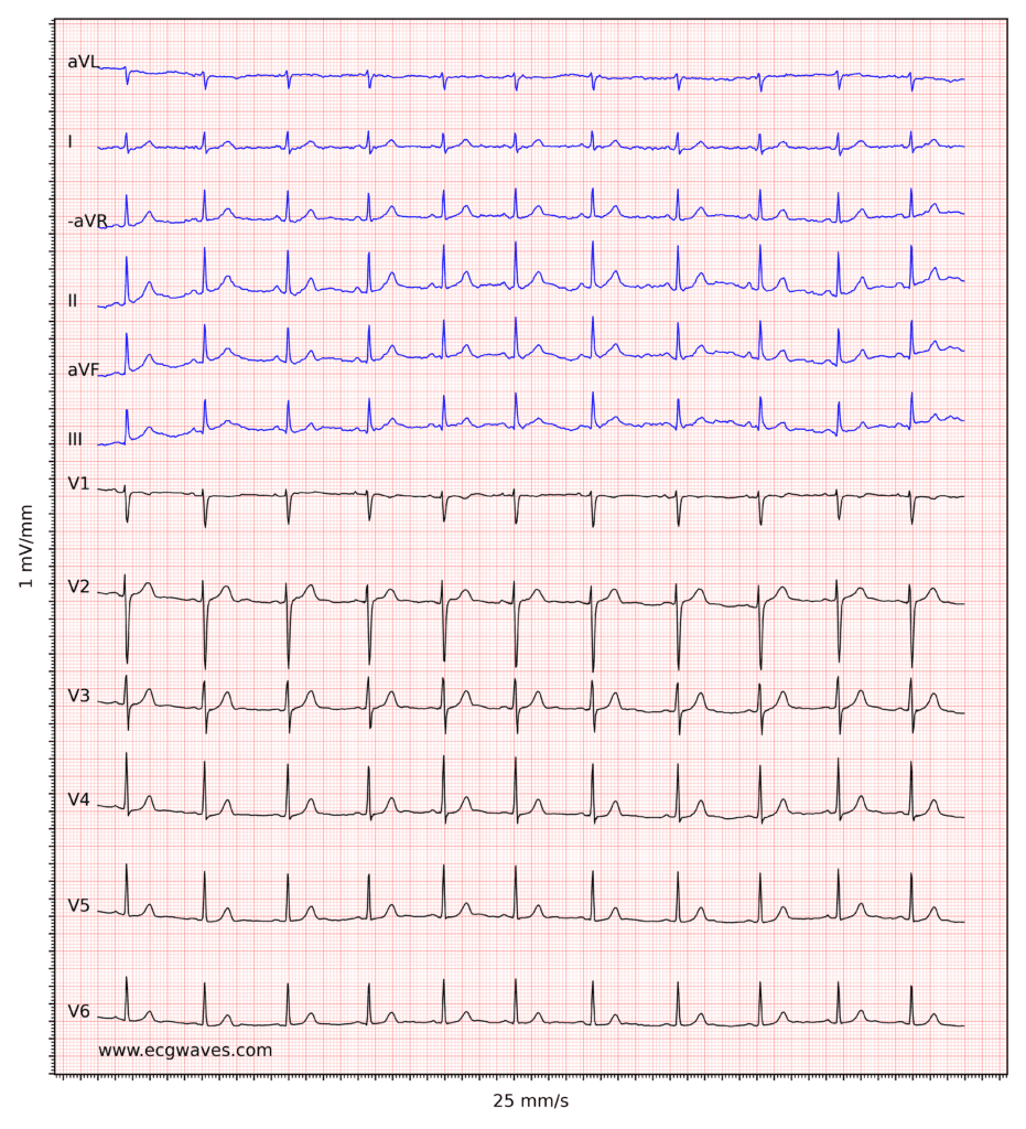 ECG example 4. Normal sinus rhythm.