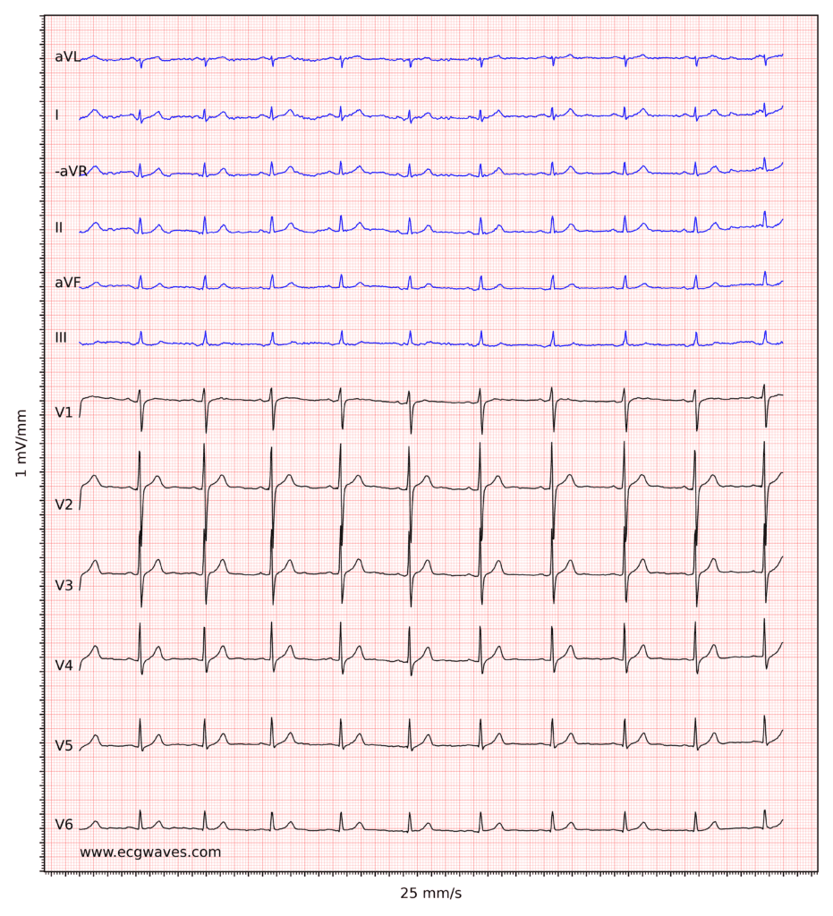 ECG example 6. Sinus rhythm, rapid progression of R-waves in precordial leads. Slight ST-segment elevation in leads V2-V3, which is normal in men and women.