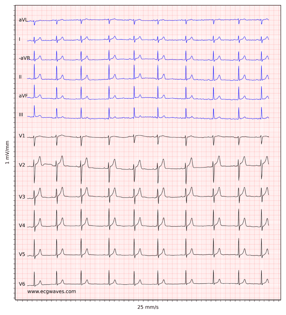 ECG example 7. Sinus rhythm. Relatively large T-waves in V2-V3, with ST-segment elevations. Relative to the R-waves, T-waves are too large and pointed (differential diagnoses are considered below).