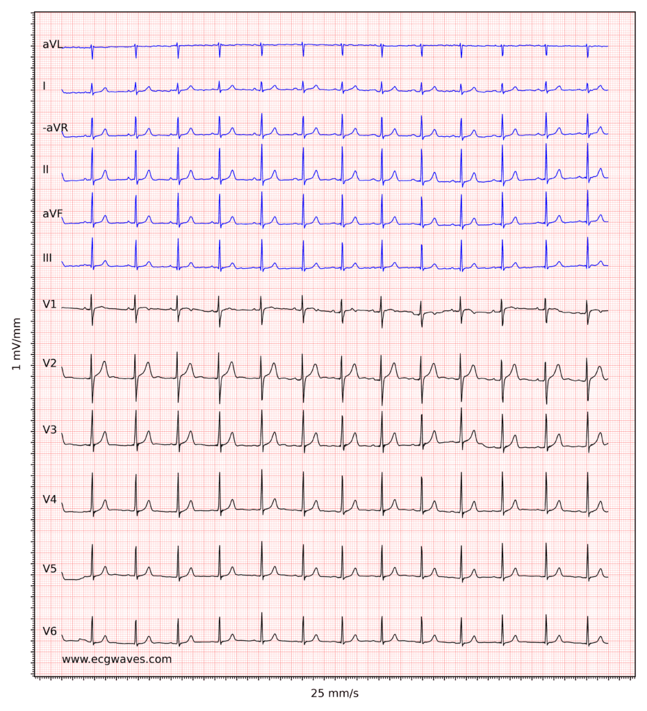 ECG example 1. Normal sinus rhythm.