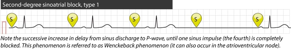 Figure 2. Type 1 second-degree sinoatrial block.
