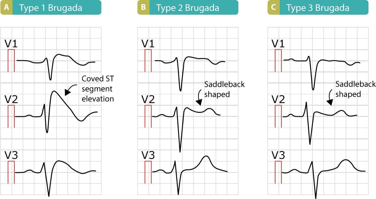 Figure 10. ECGs presenting Brugada syndrome type 1, type 2 and type 3, respectively.