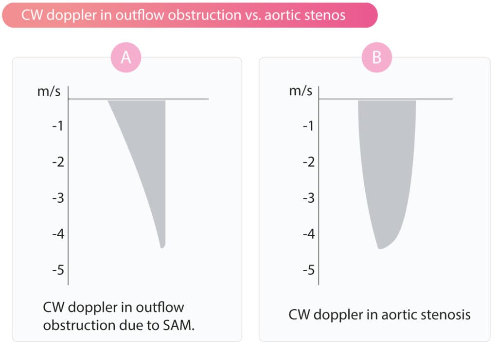 Figure 3. Continuous wave (CW) doppler in the LVOT in (A) obstruction due to SAM and septal hypertrophy and (B) aortic stenosis.