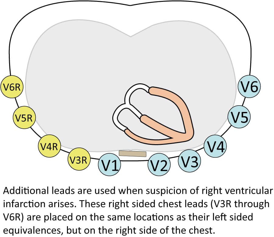 Figure 3. Right sided chest leads in right ventricular infarction.