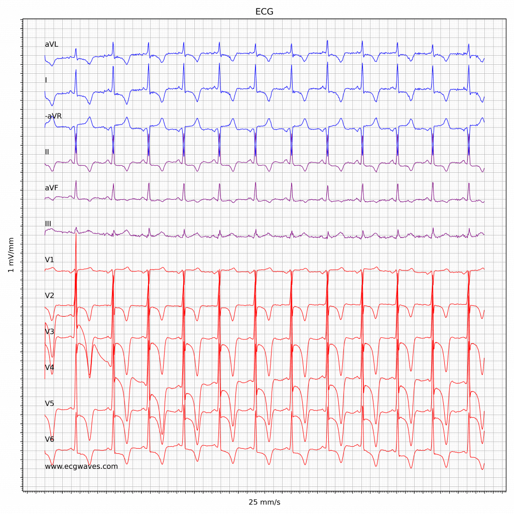 ECG in hypertrophic obstructive cardiomyopathy (HCM, HOCM)