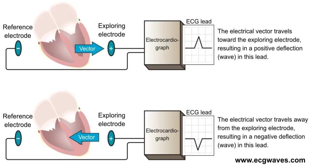 Figure 16. The electrocardiograph generates an ECG lead by comparing the electrical potential difference in two points in space. In the simplest leads these two points are two electrodes (illustrated in this figure). One electrode serves as the exploring electrode (positive) and the other as the reference electrode. The electrocardiograph is constructed such that an electrical current traveling toward the exploring electrode yields a positive deflection, and vice versa.