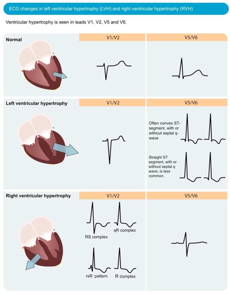Figure 1. ECG changes seen in left ventricular hypertrophy (LVH) and right ventricular hypertrophy (RVH). The electrical vector of the left ventricle is enhanced in LVH, which results in large R-waves in left-sided leads (V5, V6, aVL and I) and deep S-waves in right-sided chest leads (V1, V2). Right ventricular hypertrophy causes large R-waves in right-sided chest leads and deeper S-waves in left-sided leads.