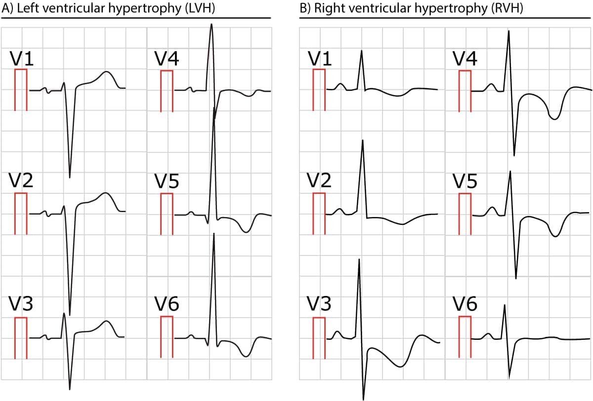 Figure 2. Two ECGs showing left and right ventricular hypertrophy.