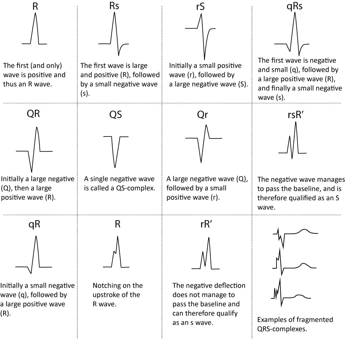 Figure 5. Naming of the QRS complex.