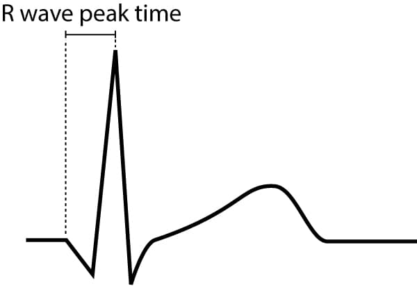 Figure 9. R-wave peak time is defined as the time interval between onset of the QRS complex to the apex of the R-wave.