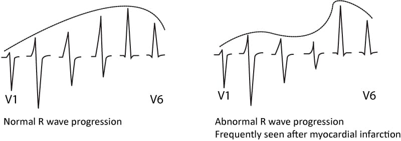 Figure 1. Pathological R-wave progression is indicative of previous myocardial infarction.