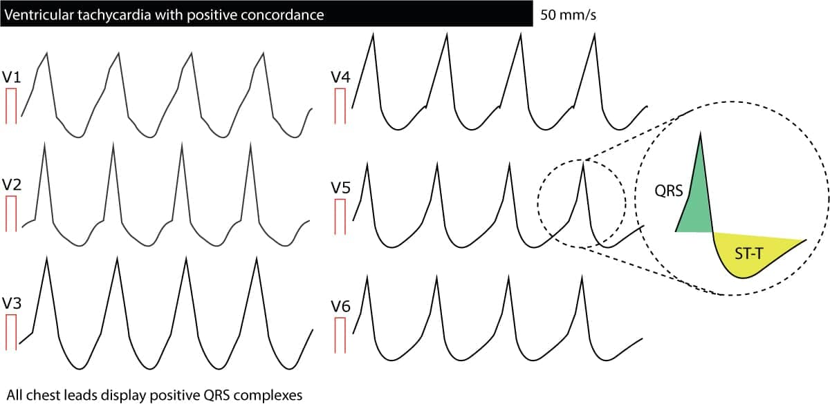 Figure 7. Concordance in QRS complexes from V1 to V6 in ventricular tachycardia.