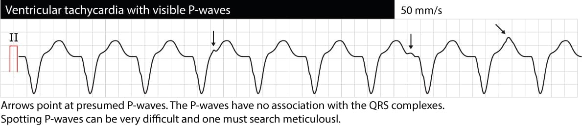 Figure 1. Monomorphic ventricular tachycardia (VT, VTach). P-waves are visible but they do not have any relation to the QRS complexes. This situation is referred to as "AV dissociation" and indicates that atrial and ventricular activity and independent. AV dissociation confirms that the arrhythmia is ventricular tachycardia. However, AV dissociation is frequently difficult to spot.