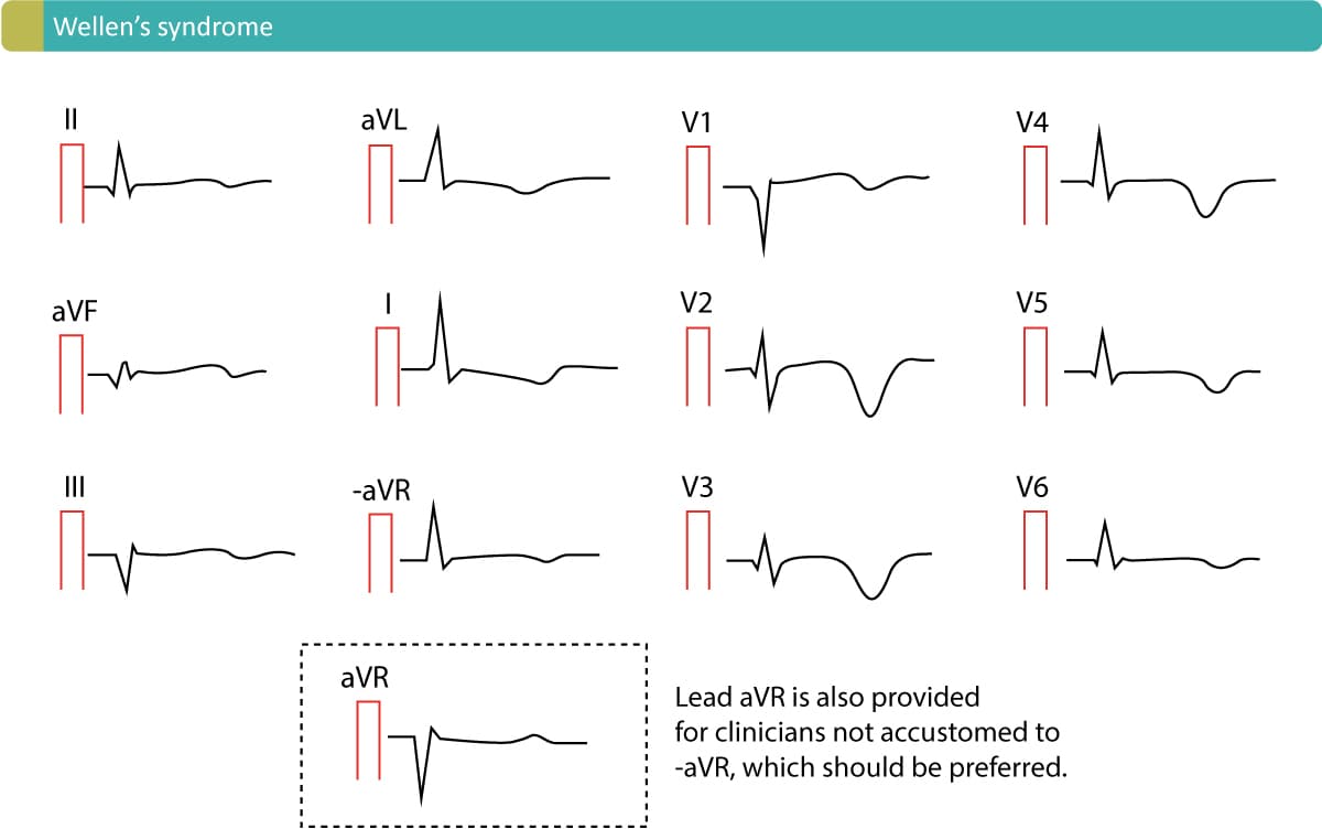 Figure 3. Characteristic T-wave inversions caused by Wellen's syndrome. This ECG pattern is commonly referred to as Wellen's sign.