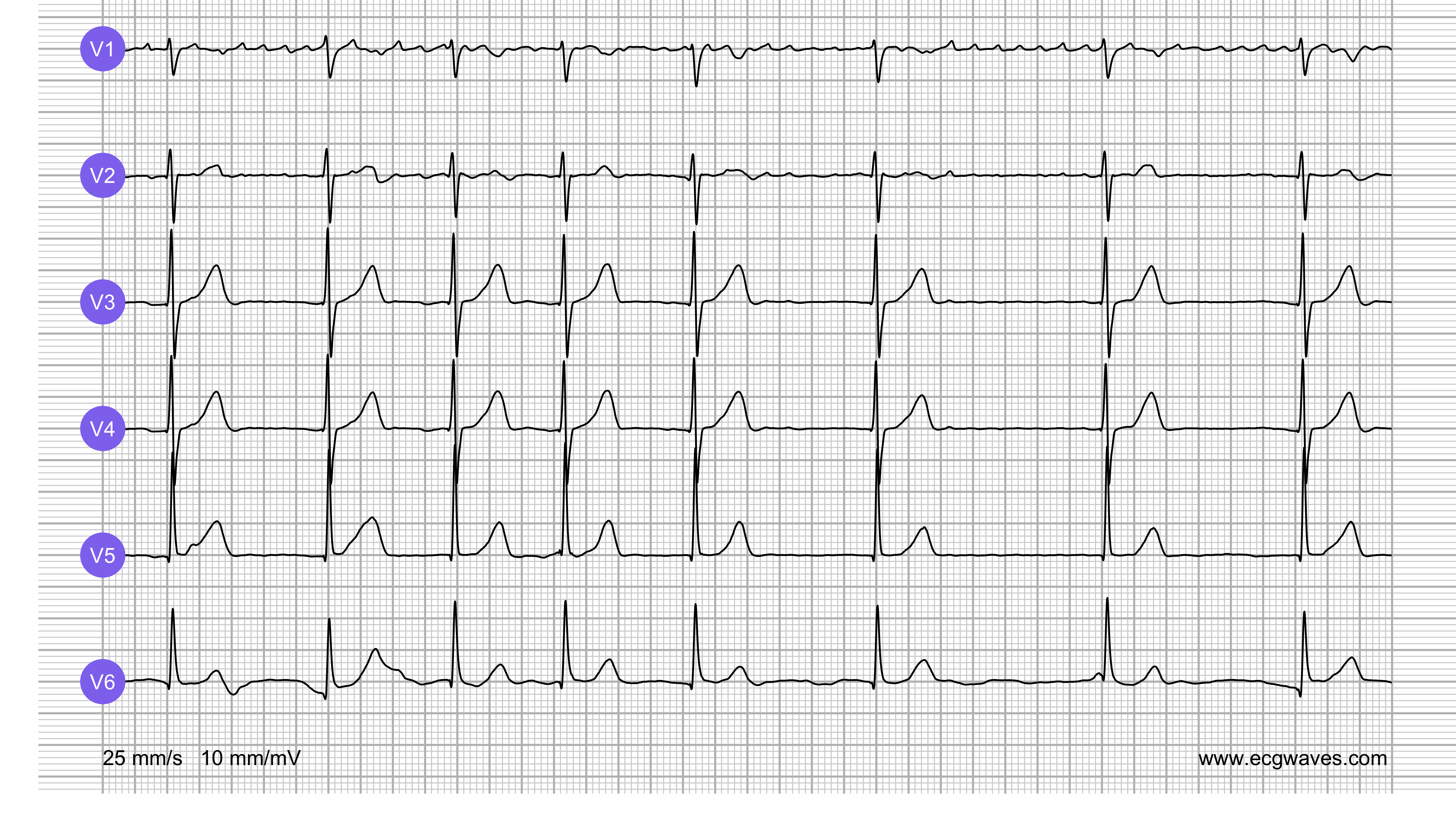 ECG Test (Quiz) Library: Question 3