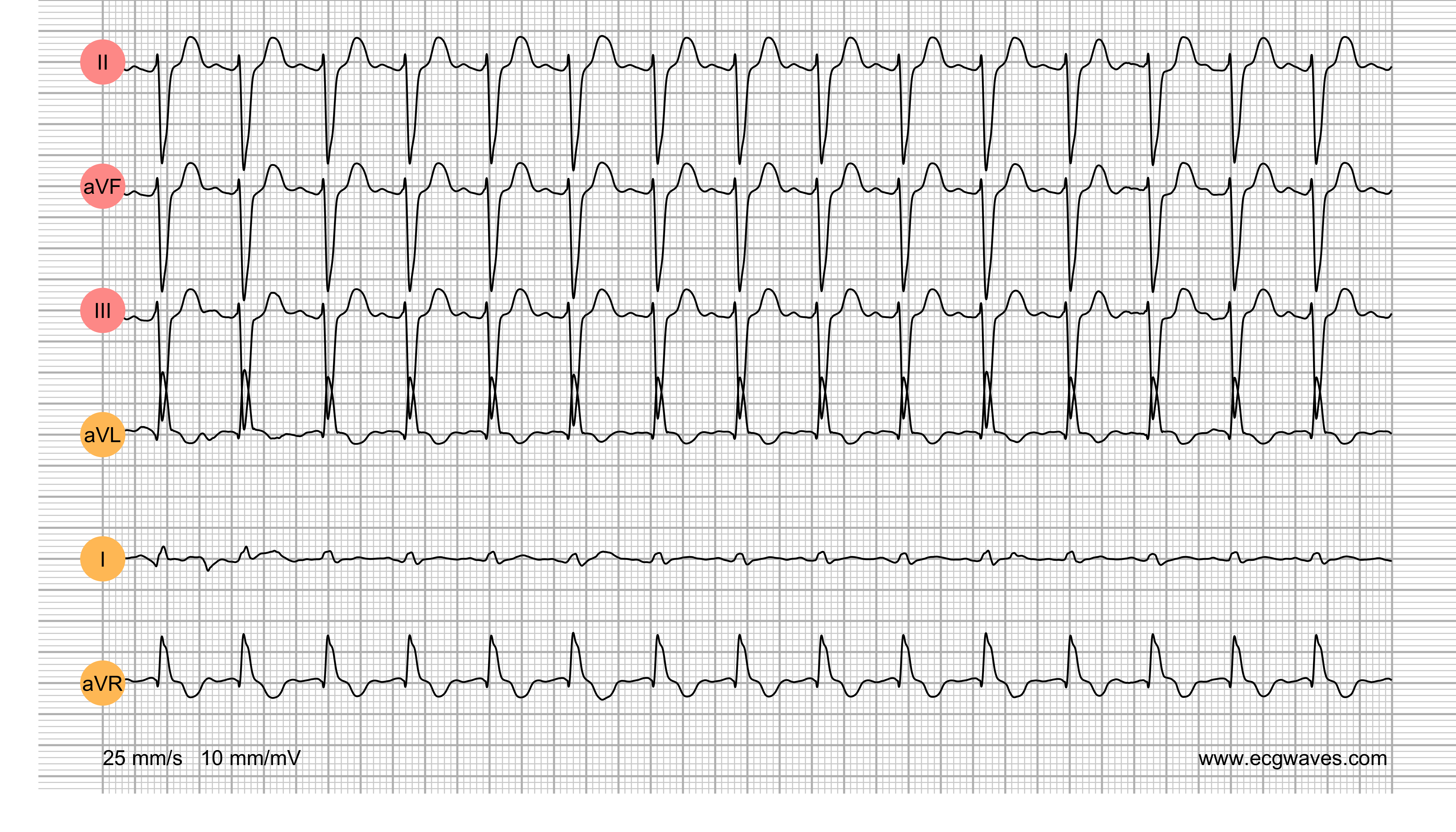 ECG Test (Quiz) Library: Question 4