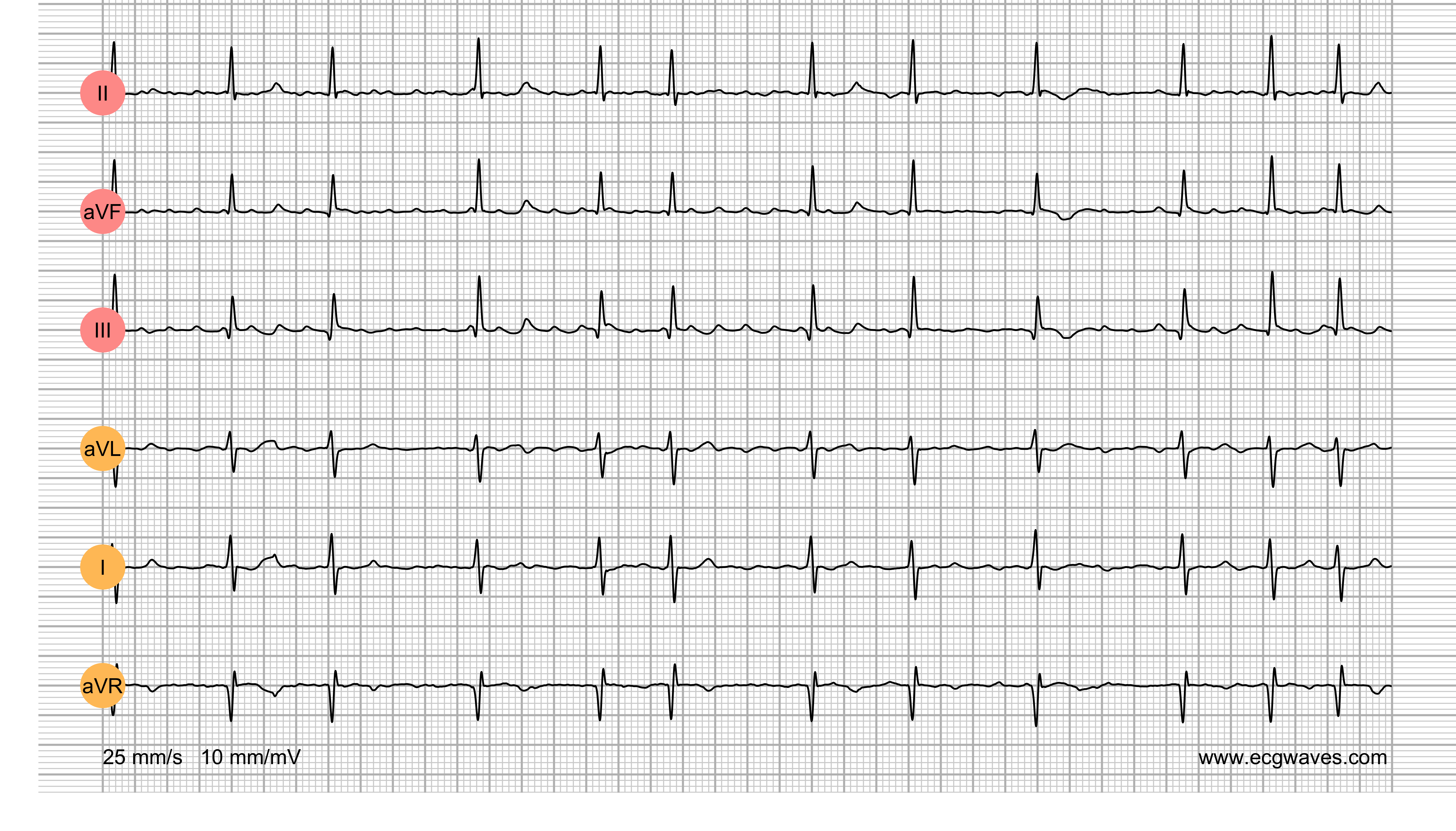 ECG Test (Quiz) Library: Question 5