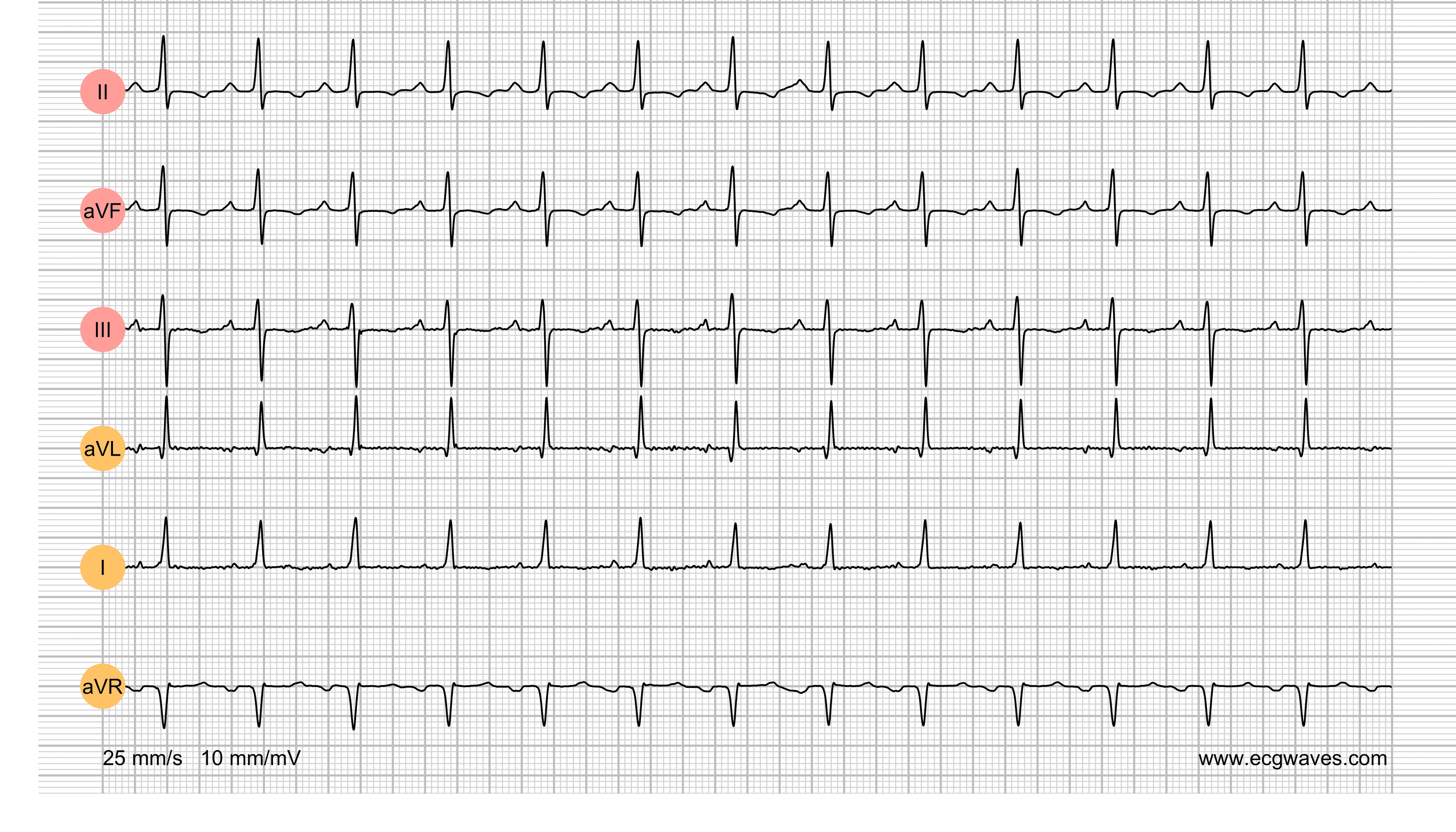ECG Test (Quiz) Library: Question 6