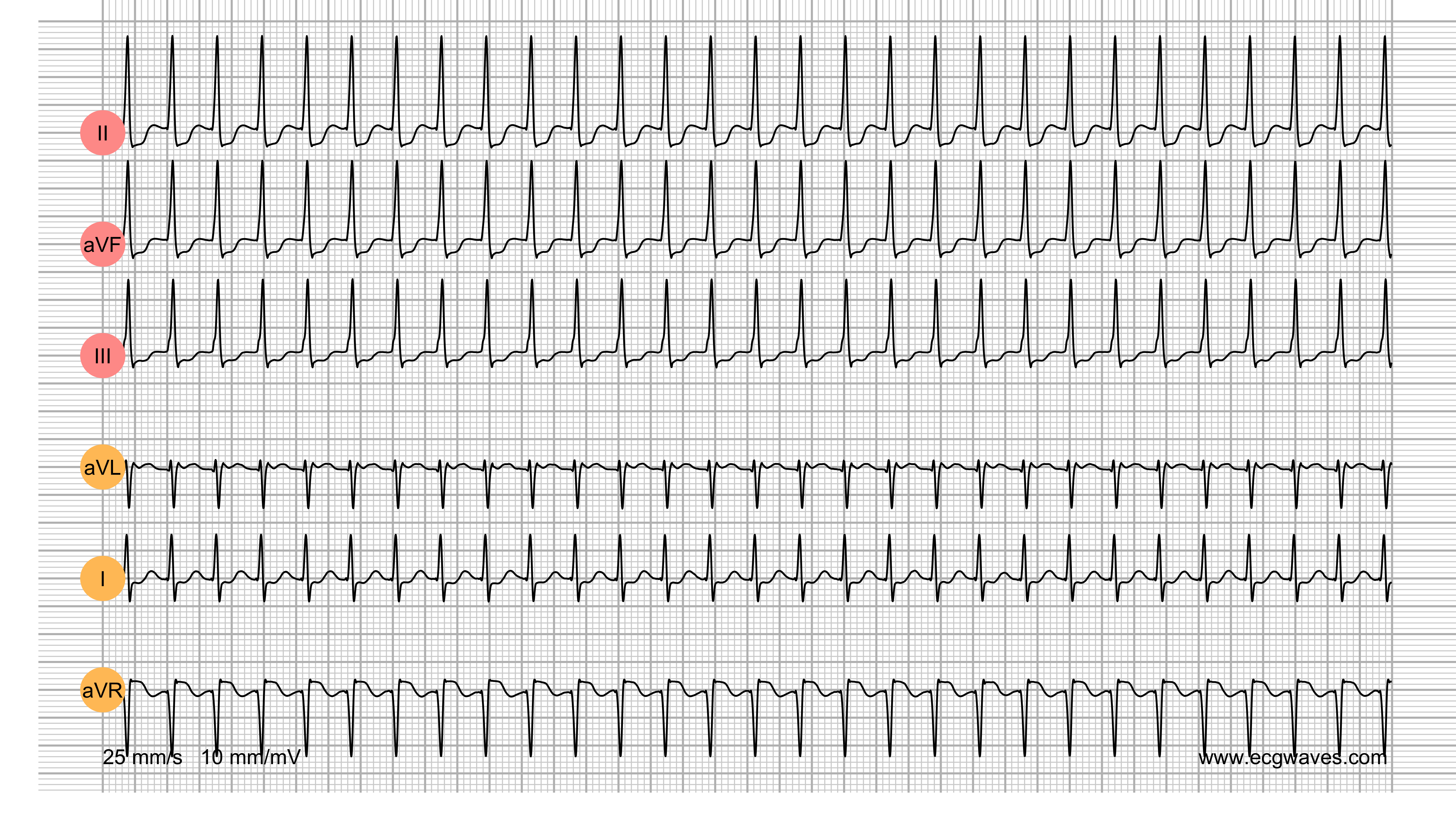 ECG Test (Quiz) Library: Question 7