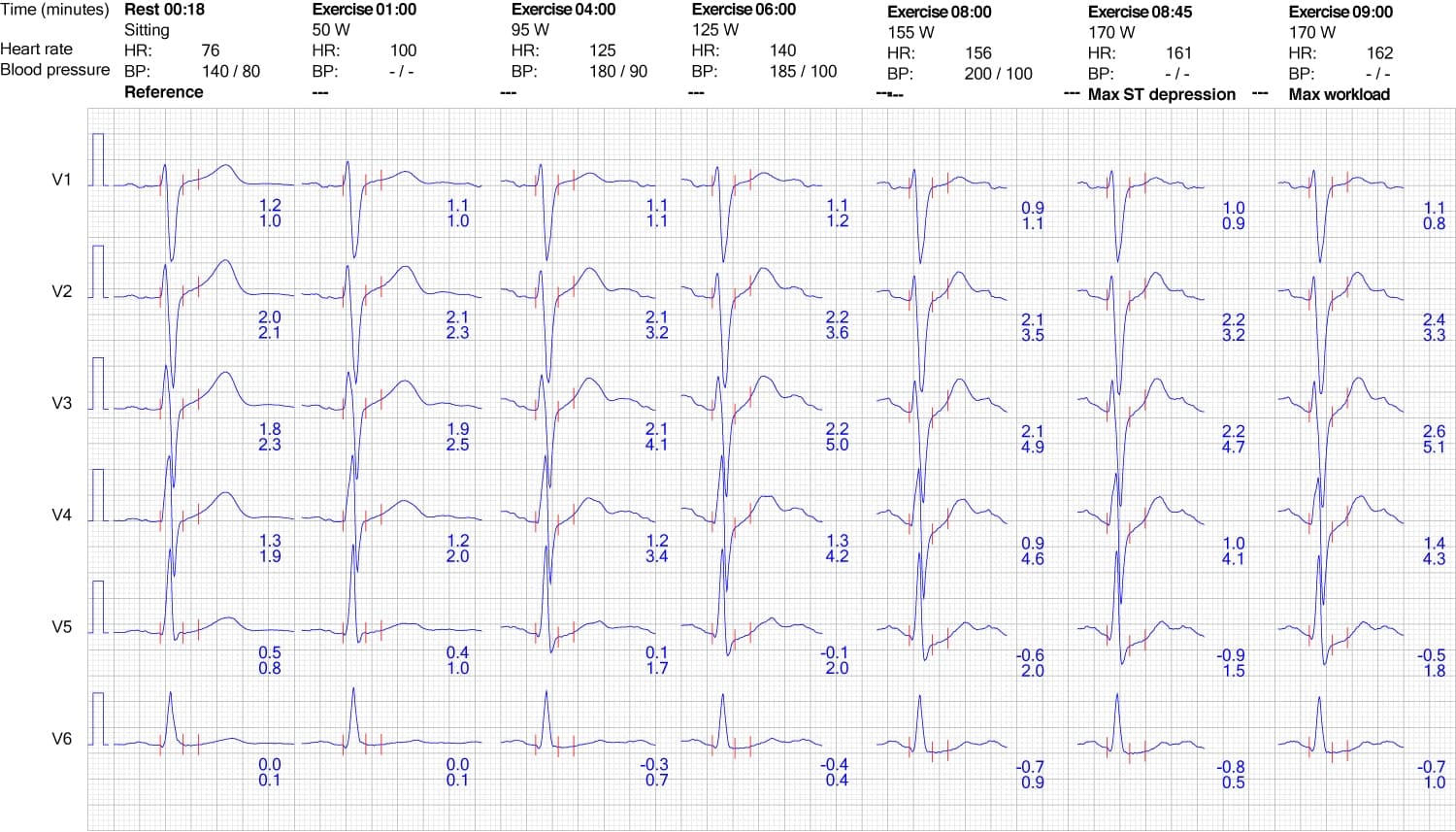 Figure 9. ECG reaction in chest leads during exercise.