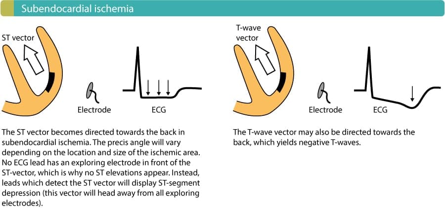 Figure 1. Exercise causes subendocardial ischemia and thus ST segment depression on the ECG.