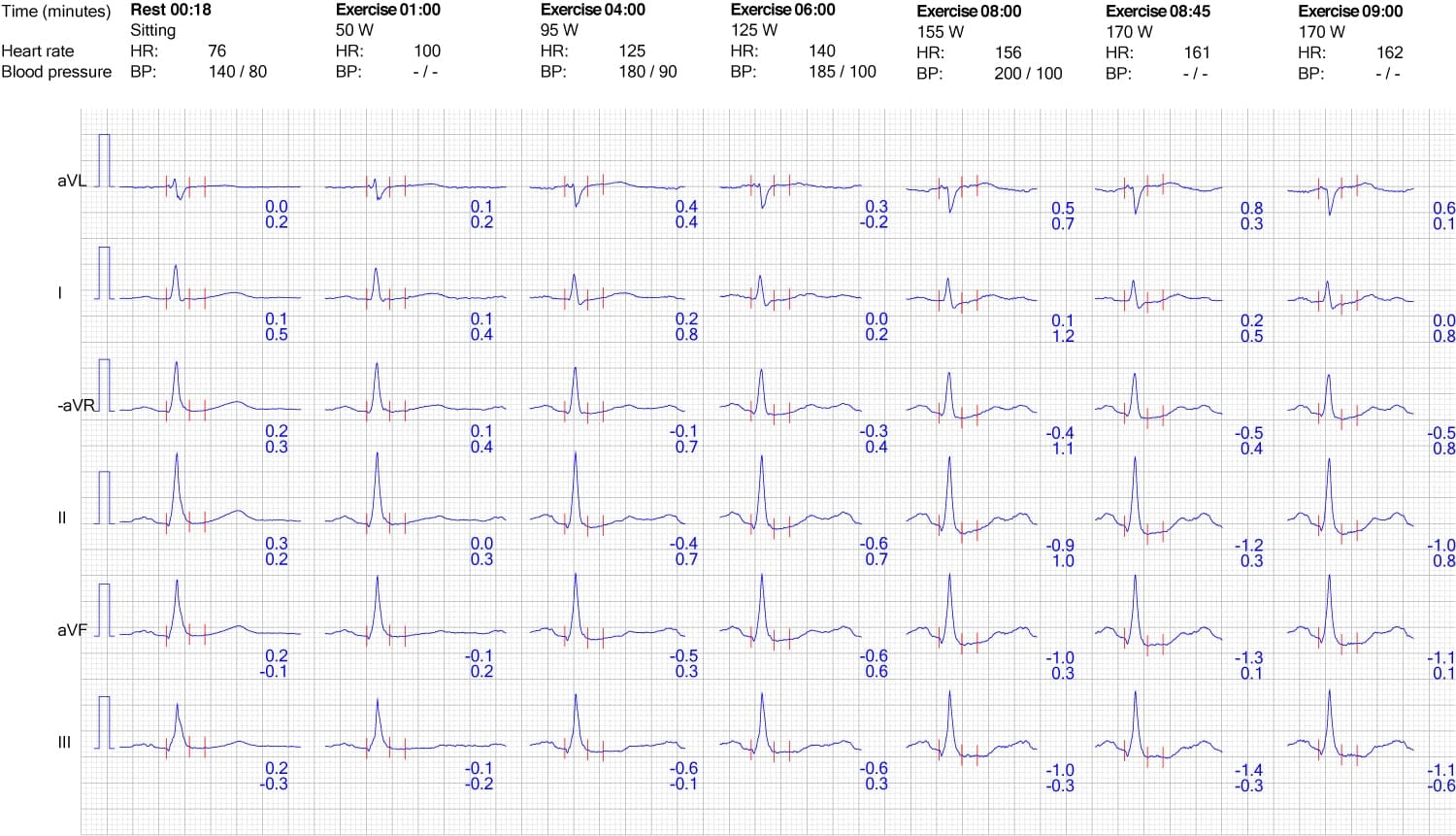 Figure 7. ECG reaction in limb leads during exercise.