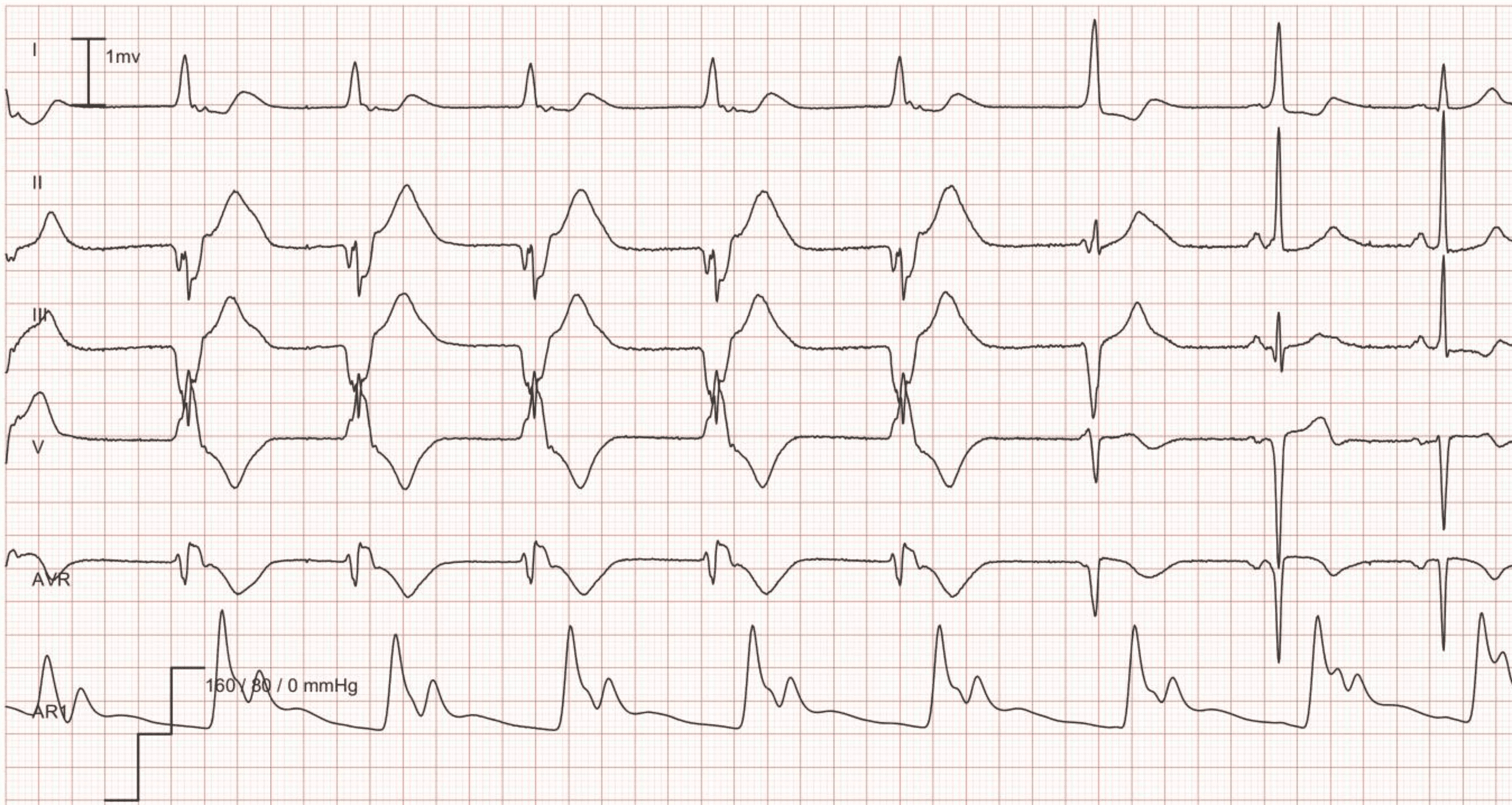 ECG Example: Idioventricular rhythm (accelerated ventricular rhythm) – Accelerated ventricular rhythm at a rate of 56 for the first 5 beats followed by 2 fusion beats; the last 2 beats are normal sinus rhythm.