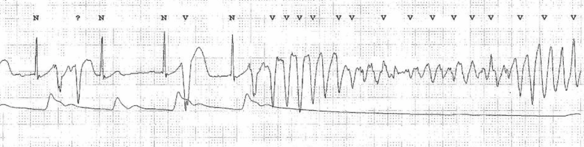 ECG showing an episode of sinus rhythm (with multiple ventricular premature beats) spontaneously converting to torsade de pointes ventricular tachycardia. Nakstad et al (Scand J Trauma Resusc Emerg Med. 2010; 18: 7)