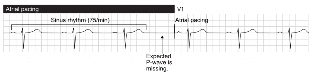 Missing, or delayed, sinus impulse invokes atrial pacing.