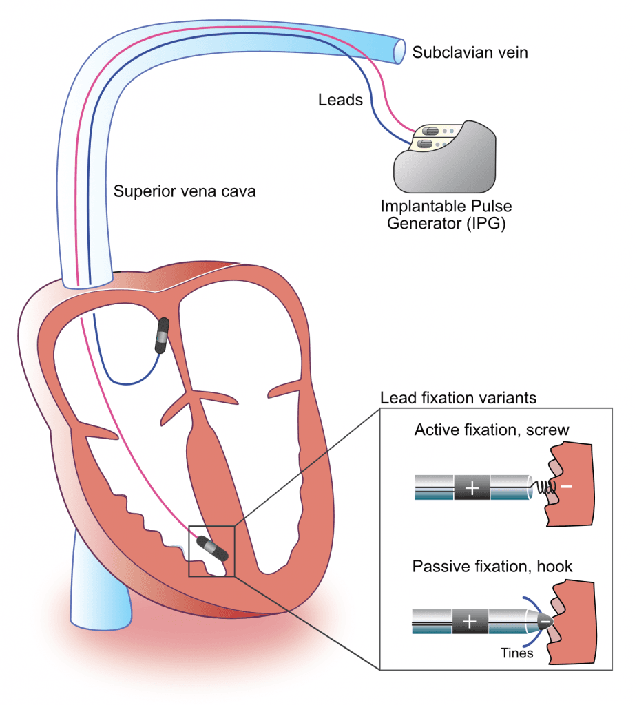 Figure 1. Components of a pacemaker.