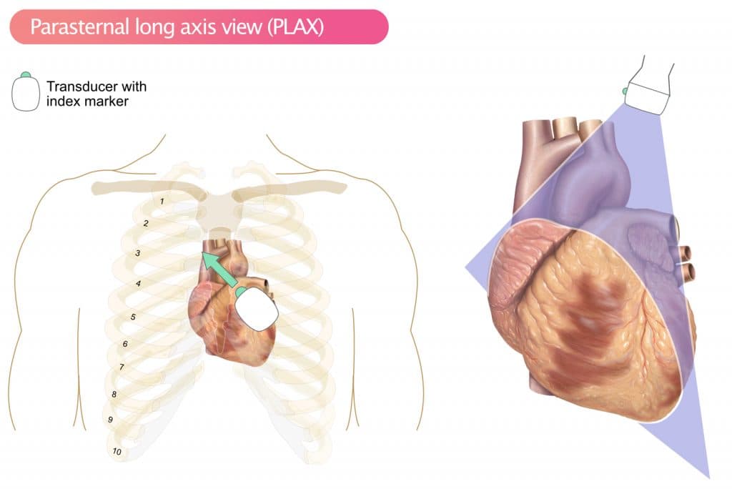 Figure 1. PLAX, Parasternal Long Axis View.