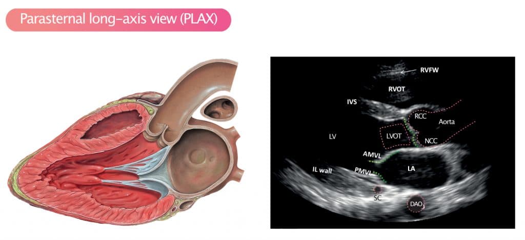 Figure 3. PLAX. RVFW = Right ventricular free wall; RVOT = Right ventricular outflow tract; RCC = right coronary cusp; NCC = Non coronary cusp; LA = left atrium; LV = Left ventricle; IL wall = inferolateral wall; IVS = Interventricular septum (anterior aspect); AMVL = Anterior mitral valve leaflet; PMVL = Posterior mitral valve leaflet; DAO = Descending aorta.