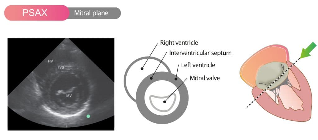 Figure 8. Parasternal short axis view (PSAX) in the mitral valve plane.