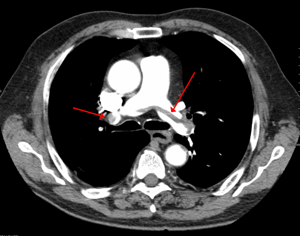 Figure 2. CTPA showing large pulmonary embolism at the bifurcation of the pulmonary artery (saddle embolism).