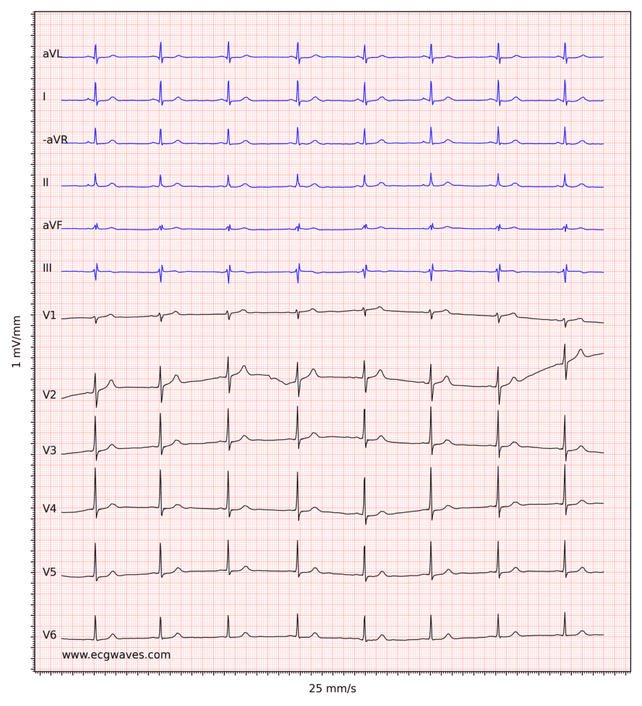 Figure 4. Sinus bradycardia.
