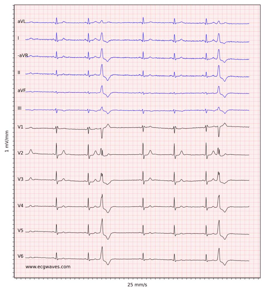 Figure 2. Sinus bradycardia, premature ventricular contractions, incomplete right bundle branch block and ST-segment depressions in V2-V6.