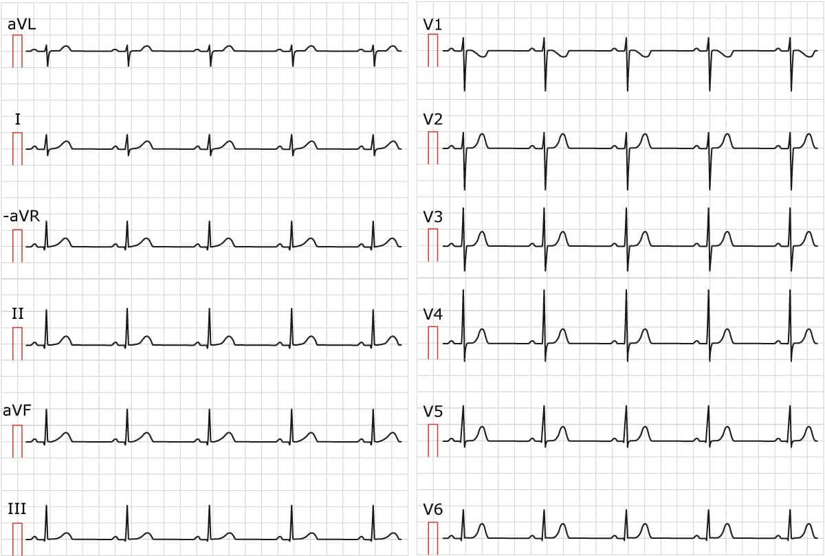 Figure 1. Sinus rhythm. Paper speed 25 mm/s.