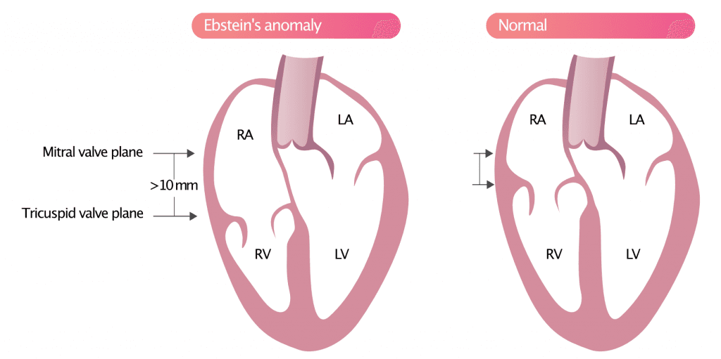 Ebstein's anomaly.