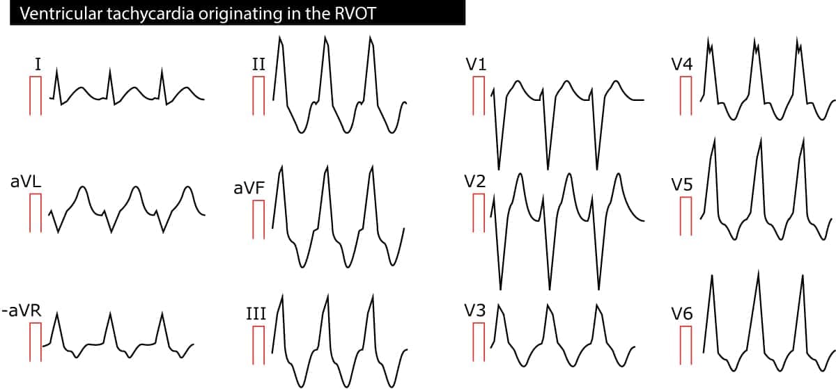 Figure 2. Ventricular tachycardia (VT) originating in the right ventricular outflow tract (RVOT).